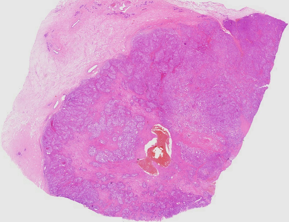 Breast Ductal Carcinoma-41-20x